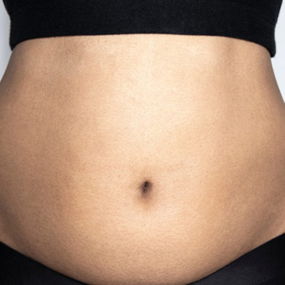 Weight Loss - Before