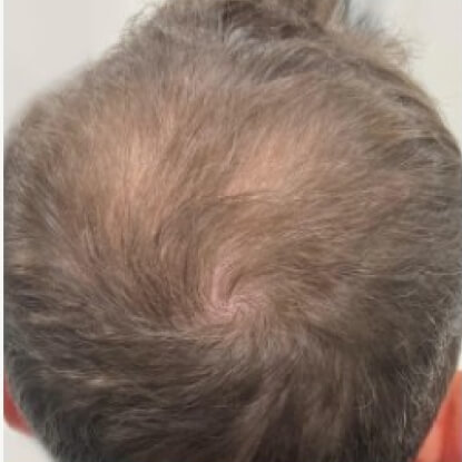 before-after-hair-1-a