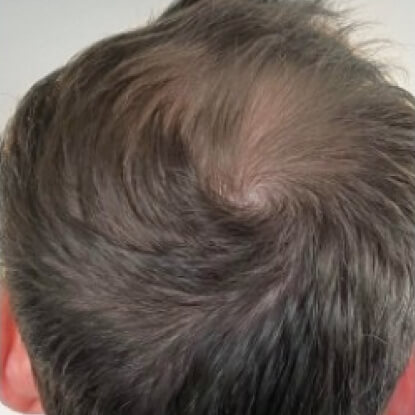 before-after-hair-1-b
