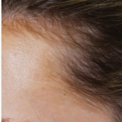before-after-hair-2-b