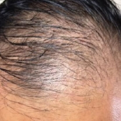 before-after-hair-3-a