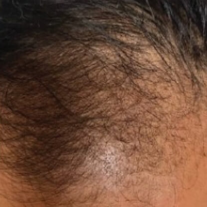 before-after-hair-3-b