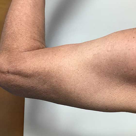 before-after-arms-after