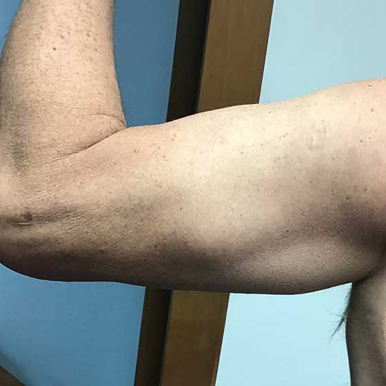 before-after-arms-before