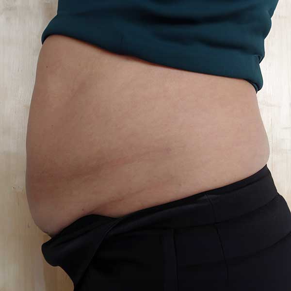before-afters-stomach-before