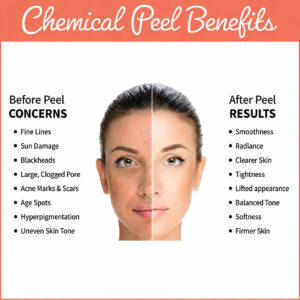 Chemical Peels